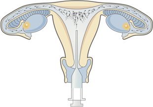 Femme célibataire insémination artificielle belgique