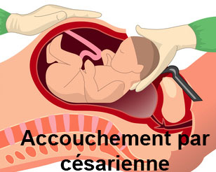 Césarienne
