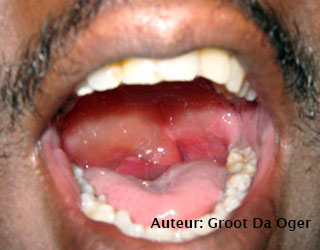 most cancers des ovaires et de l'utérus