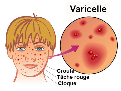 Le masque pour la personne avec lalbumine pour la peau problématique
