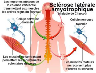 maladie de charcot
