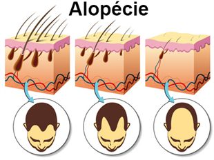 Alopécie : symptômes, traitement, définition - docteurclic.com Alopécie : symptômes, traitement, définition - docteurclic.com