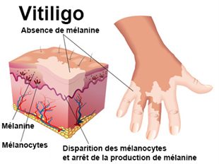Comme éloigner les taches de pigment du soleil