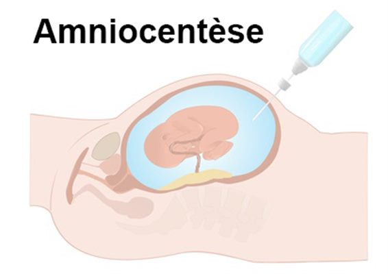 Amniocentèse