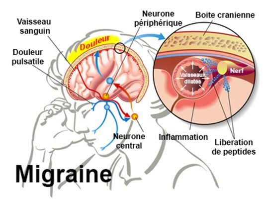 Que faire en cas  de migraine?
