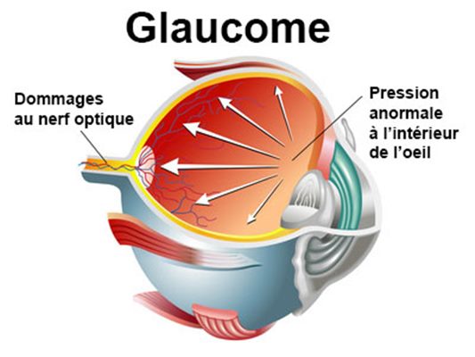 Glaucome : maladie oculaire