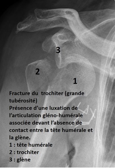 Fracture de l'épaule (l’extrémité de l’humérus)