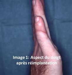 Aspect du doigt après réimplantation 