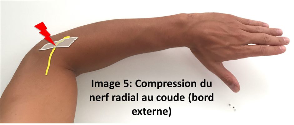 Compression du nerf radial au coude