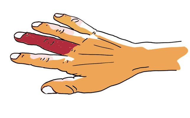 Hématome d'un doigt - Apoplexie digitale idiopathique