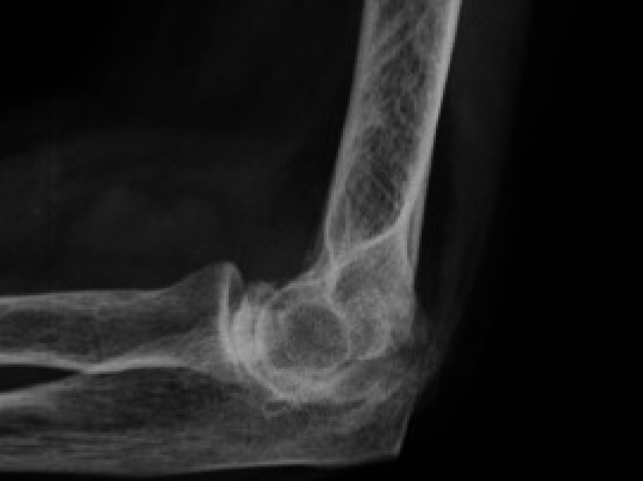 Arthrose du coude traitement, définition