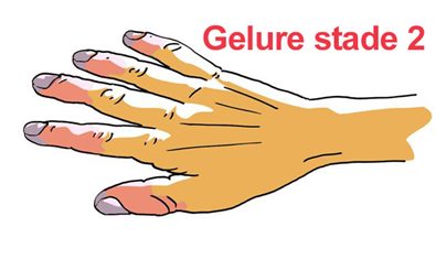 gelure de la main - stade 2