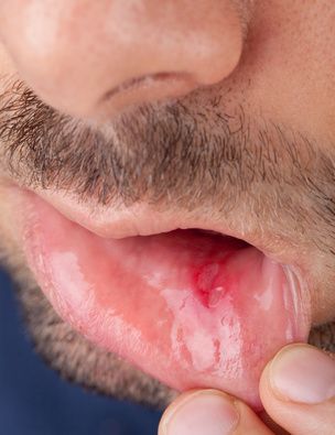 Que Faire En Cas D Aphte Docteurclic Com