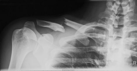 fracture de la clavicule