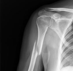 fracture du bras