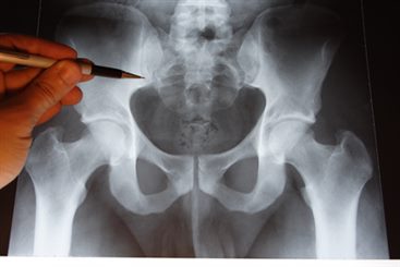 fracture du bassin