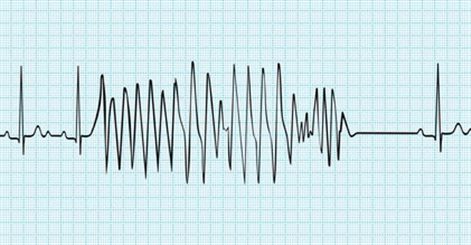 Tachycardie : symptômes, traitement, définition - docteurclic.com