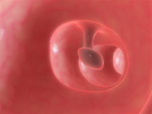 Polype de l'oesophage