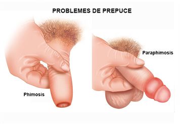 phimosis