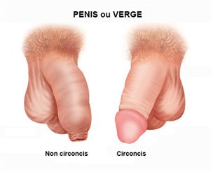 circoncision