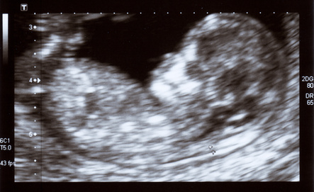 Troisieme Echographie De La Grossesse Symptomes Traitement Definition Docteurclic Com Troisieme Echographie De La Grossesse Symptomes Traitement Definition Docteurclic Com