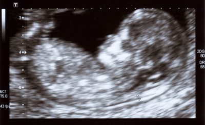 Deuxieme Echographie De La Grossesse Symptomes Traitement Definition Docteurclic Com