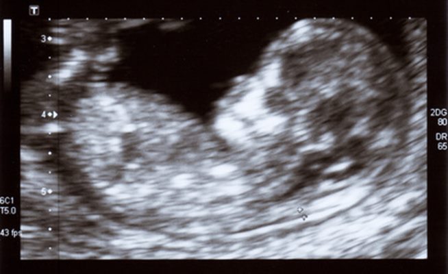 Troisième échographie de la grossesse