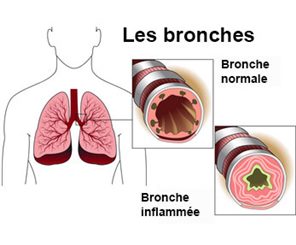 bronches inflammées