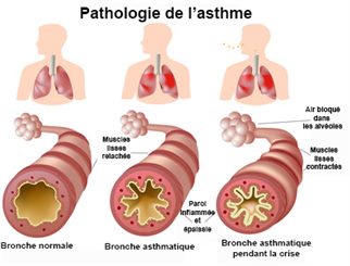 crise d'asthme