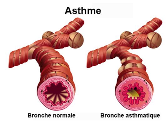 Asthme professionnel