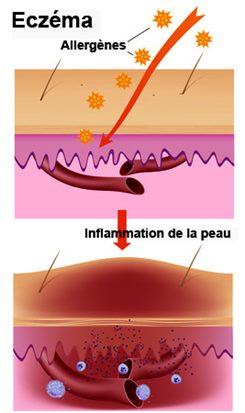 Schéma de l'eczéma