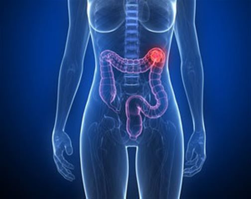 cancer colon gauche symptomes paraziți ai organelor interne și tratamentul acestora