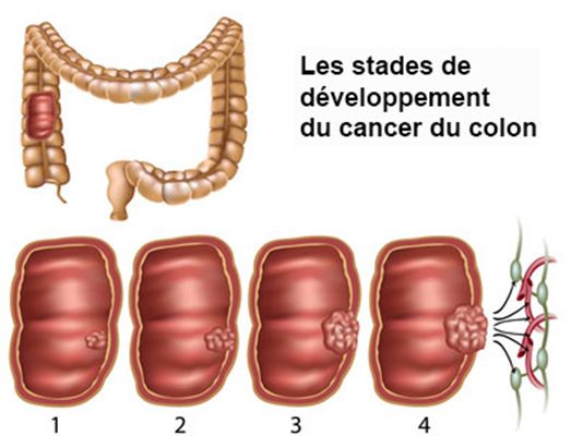 cancer colon recidive ganglion)