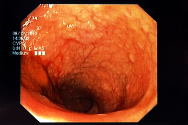 Colopathie : symptômes, traitement, définition - docteurclic.com