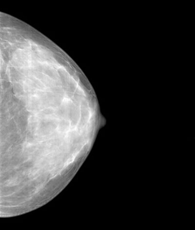 Prise en charge d'un cancer du sein