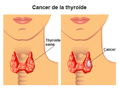 Cancer de la thyroïde : symptômes, traitement, définition ...
