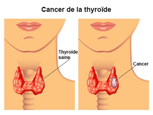 Cancer de la thyroïde :  des réponses à vos questions