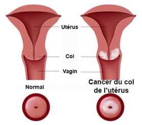 cancer du col de l'utérus