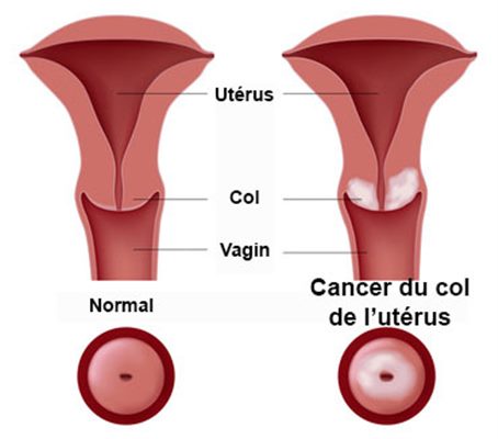 Cancer du col de l'utérus : symptômes, traitement, définition ...