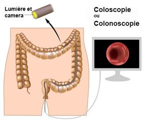 coloscopie