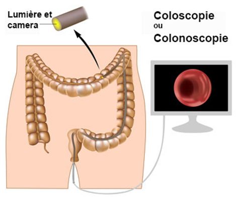 Coloscopie, colonoscopie