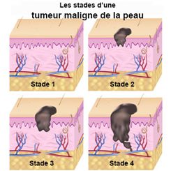tumeur maligne de la peau