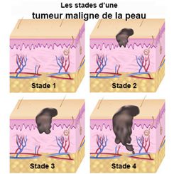 Boules sous la peau : symptômes, traitement, définition ...