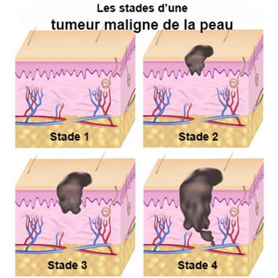 Tumeurs de la peau