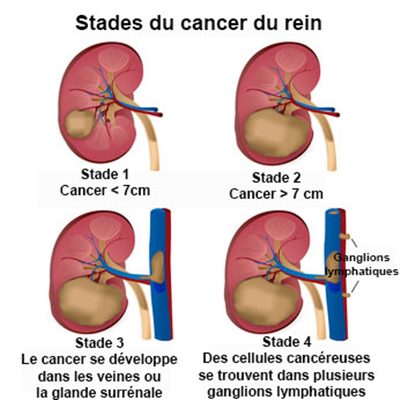 Cancer du rein : symptômes, traitement, définition - docteurclic.com