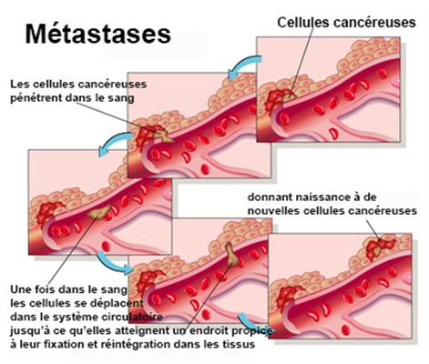 Métastase