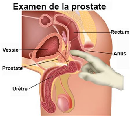 Dépistage du cancer de la prostate