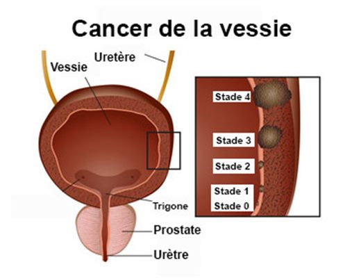 Cancer de la vessie