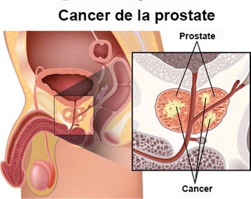 cancer de la prostate inervación de la próstata