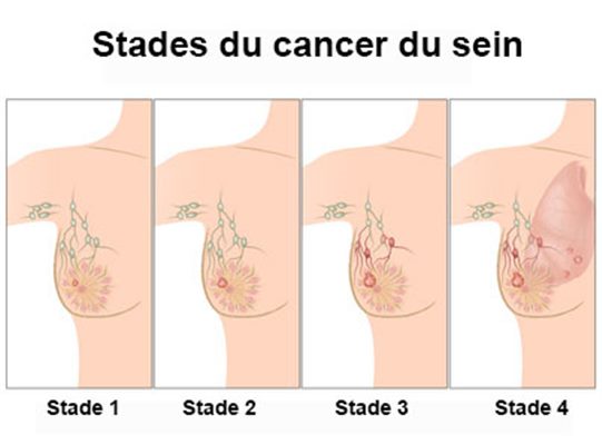 Cancer du sein : définition 